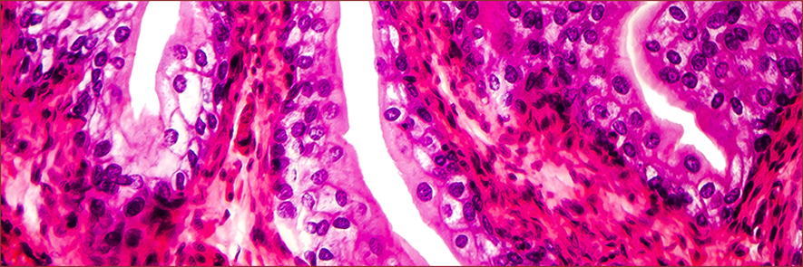  Adjuvant Chemotherapy in Upper-Tract Urothelial Cancer Shows Impressive Gains in the POUT Trial